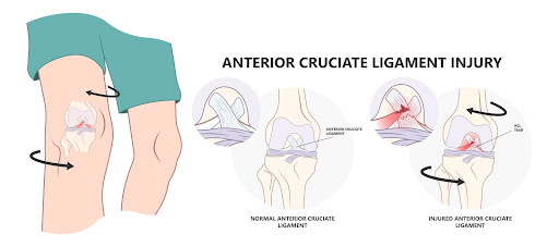 Anterior Cruciate Ligament Injury